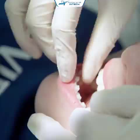 KHẮC PHỤC HOÀN TOÀN TÌNH TRẠNG KHẤP KHỂNH - KHỚP CẮN HỞ SAU 2 NĂM NIỀNG RĂNG CÔNG NGHỆ X-MATRIX