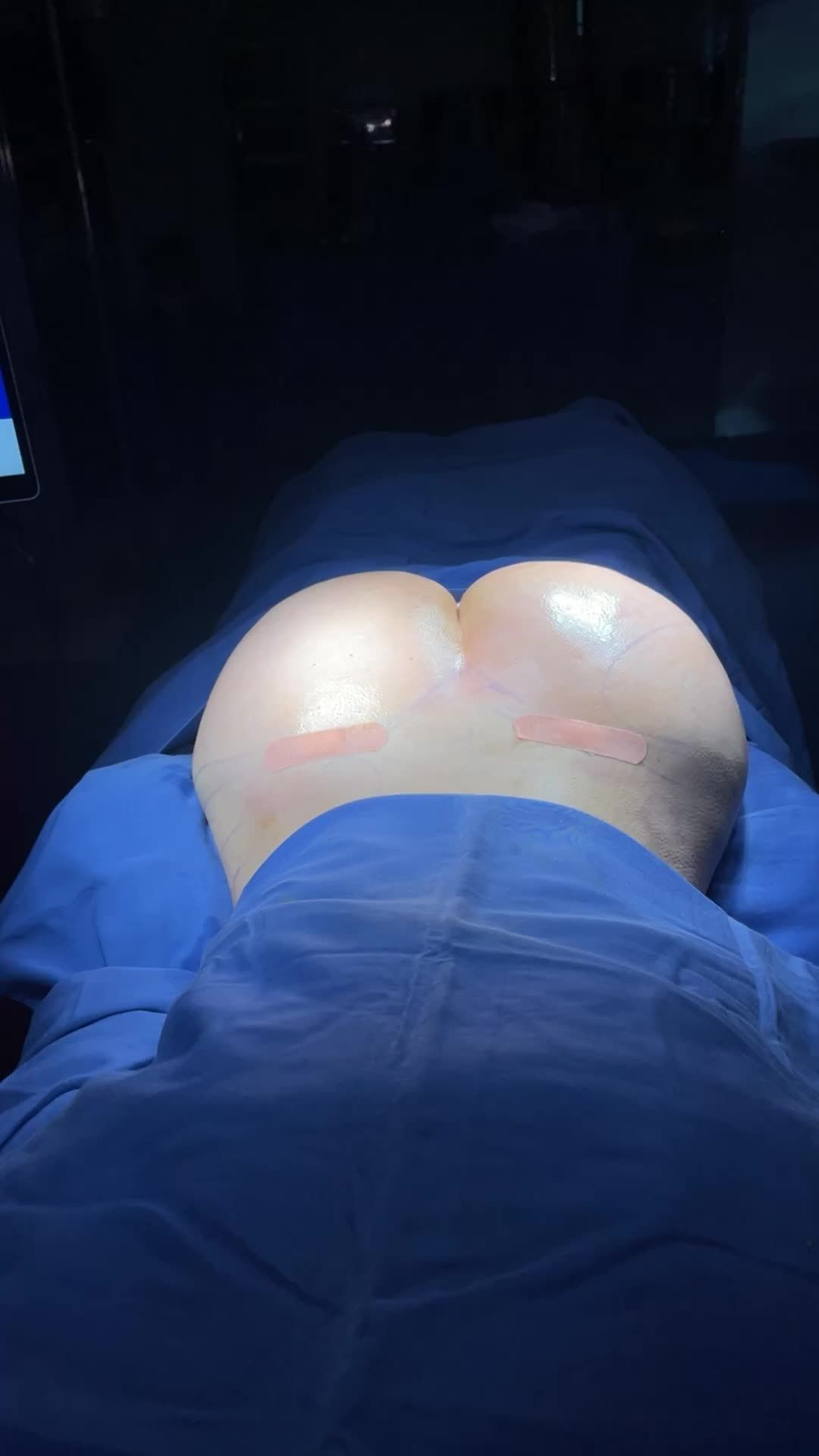 Kết quả phẫu thuật nâng mông bằng mỡ tự thân tại Kangnam