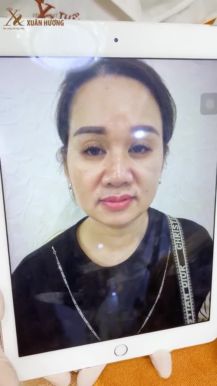 BẤT NGỜ VỚI LÀN DA SÁNG, MƯỚT MỊN, MỜ THÂM NÁM CHỈ SAU 3 BUỔI TRẺ HOÁ DA BABY FACE KẾT HỢP TRỊ NÁM