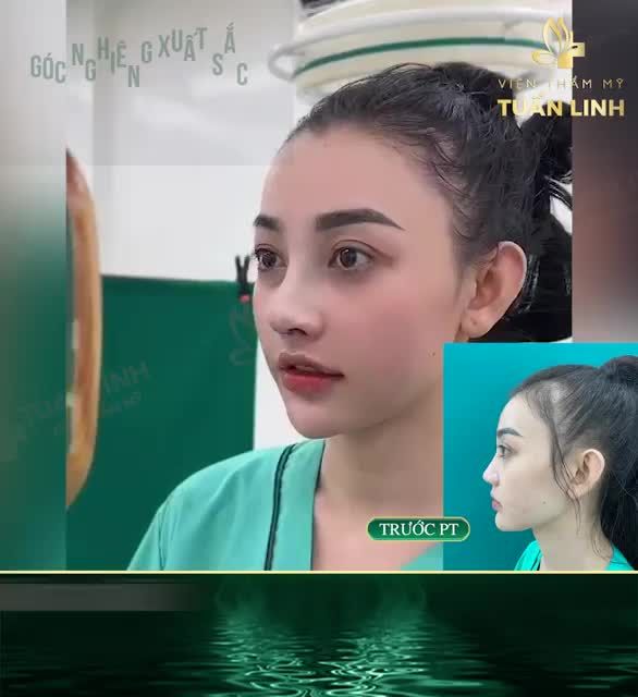 Sở hữu ngay dáng mũi cao tây đẹp chuẩn Hotgirl chỉ sau 90 phút thực hiện.