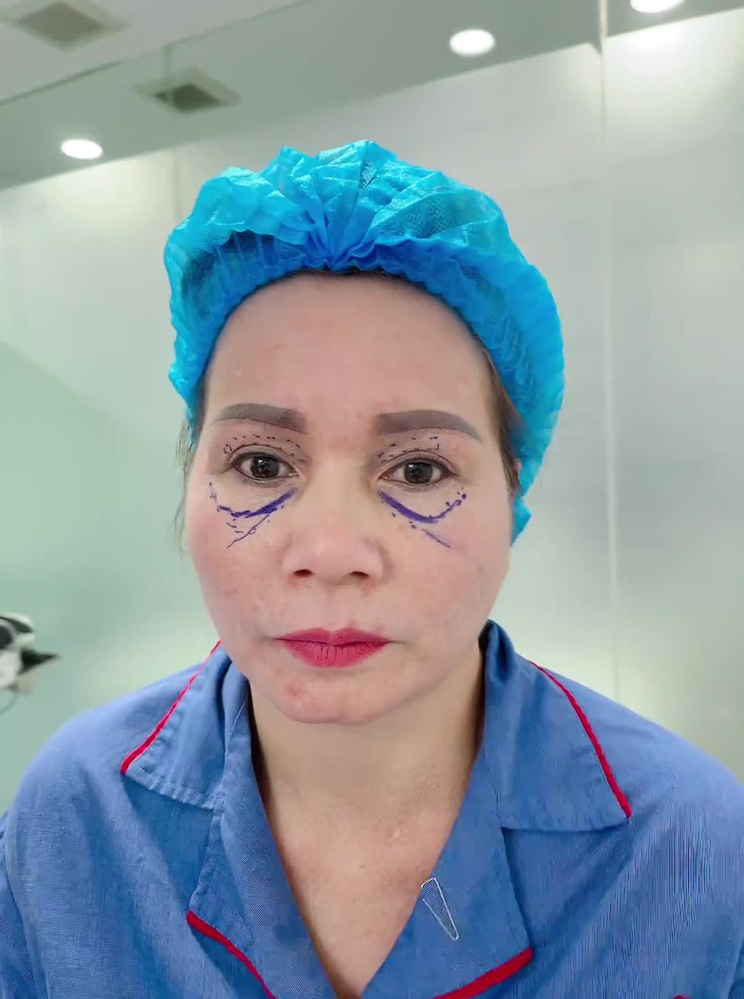 Bác sĩ tại Kangnam sẽ thực hiện công nghệ gì? Phương pháp nào để trẻ hóa đôi mắt cho cô khách hàng đến từ Hà Nội