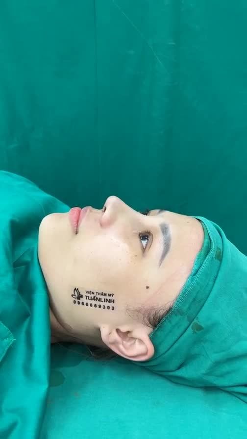 Case mũi cấu trúc vừa hoàn thành