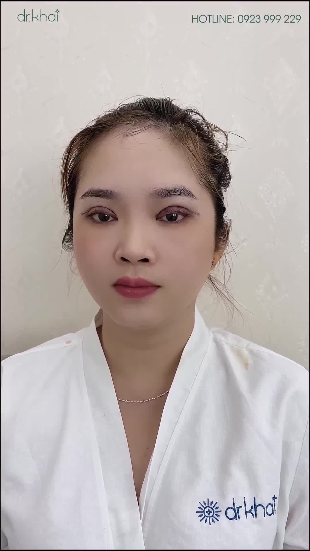 HOÀN THÀNH CA PHẪU THUẬT CẮT MÍ, XỬ LÝ CHỈ VÙNG MẮT TRÊN