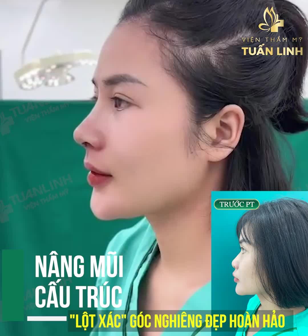Khắc phục tình trạng mũi th.ấp và ng.ắn cho cô nàng 2K2!!