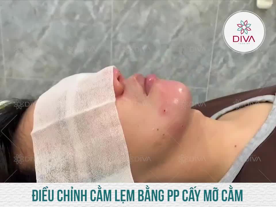 CẰM VLINE CHUẨN TỈ LỆ VÀNG SAU CẤY MỠ COLEMAN