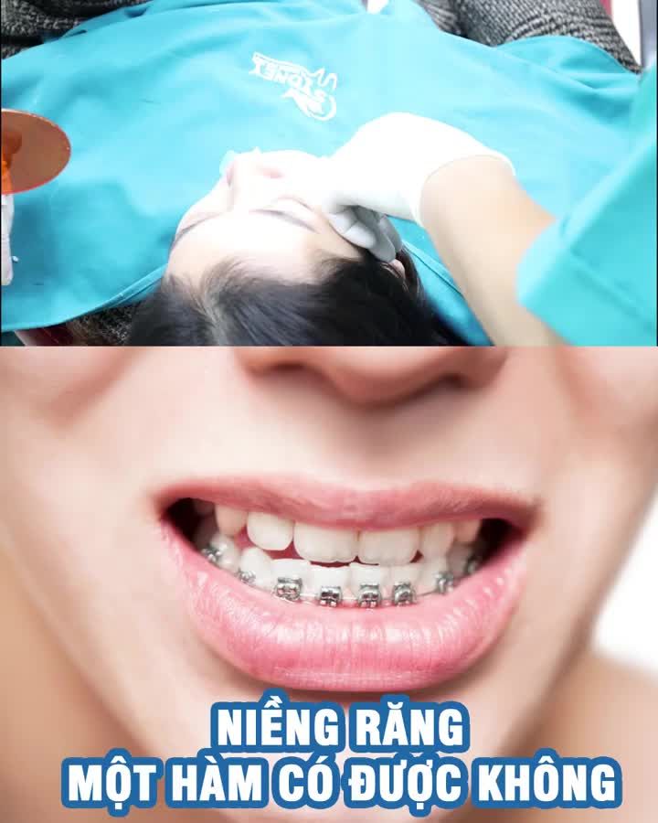 Niềng răng 1 hàm có được không?