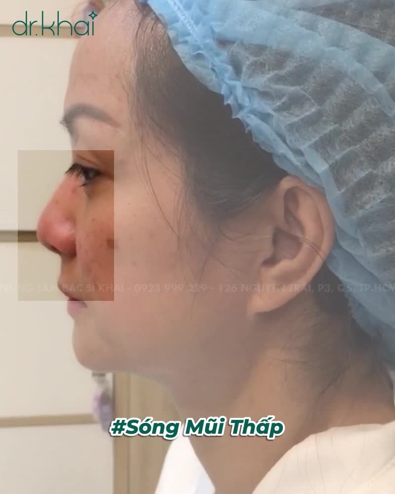 KHÁCH MỸ VỀ VN NÂNG MŨI, CẮT MÍ CÔNG NGHỆ NÂNG MŨI ĐỘC QUYỀN TRUNG TÂM BS KHẢI