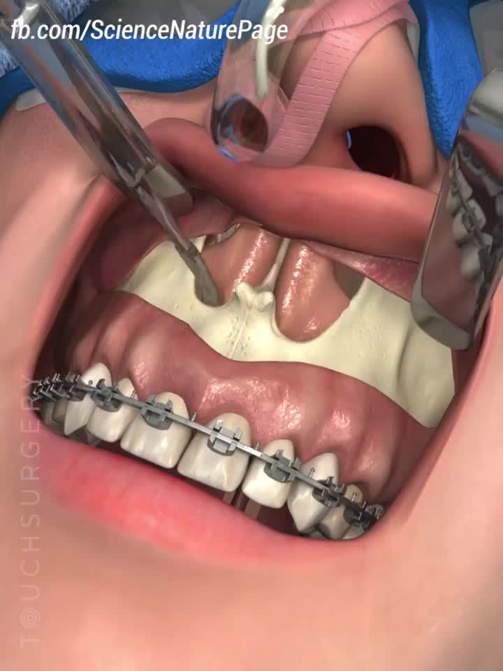 Niềng răng kết hợp phẫu thuật xương hàm !