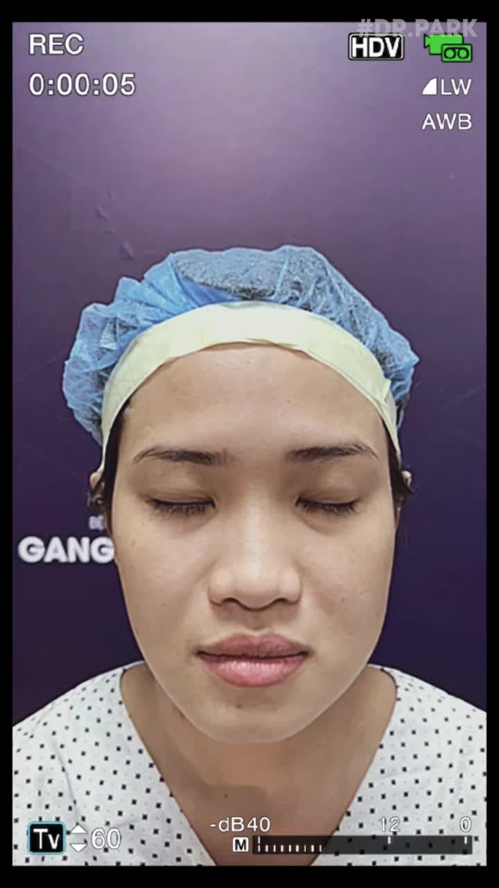 CẮT MÍ EYELID MANG LẠI CHO BẠN ĐIỀU GÌ?