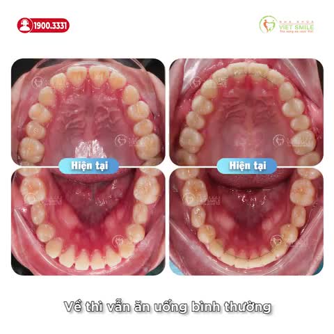 NIỀNG RĂNG THƯA KHÔNG ĐAU, TĂNG CÂN NHIỀU HƠN
