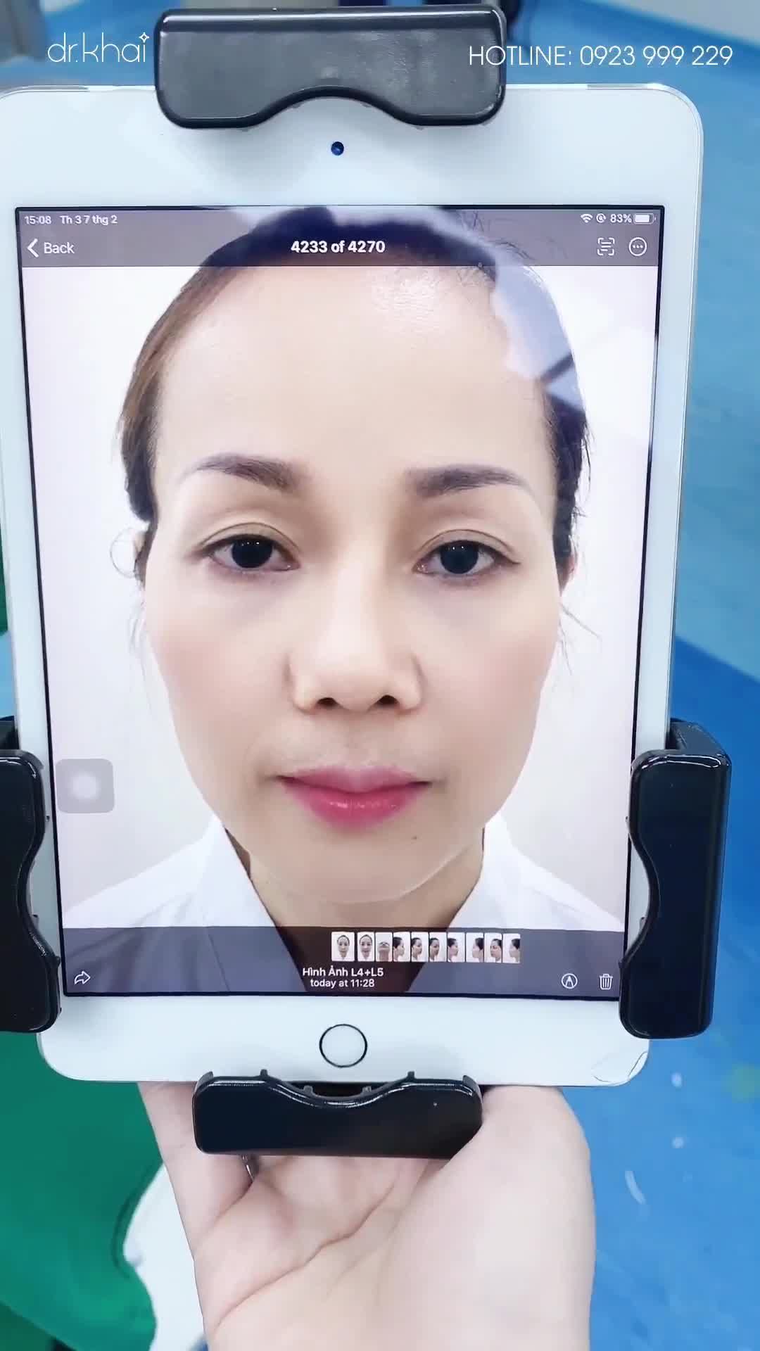 BÁC SĨ KHẢI VỪA HOÀN THÀNH CA MŨI CẤU TRÚC CHỈNH XƯƠNG KẾT HỢP CHỈNH HỞ LỖ MŨI RẤT KHÓ