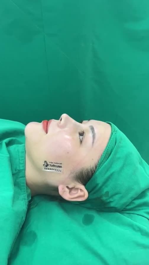Viện thẩm mỹ Tuấn Linh khai Xuân,  với ca combo nâng mũi cấu trúc và độn cằm cho ban gái từ Đồng Tháp lên