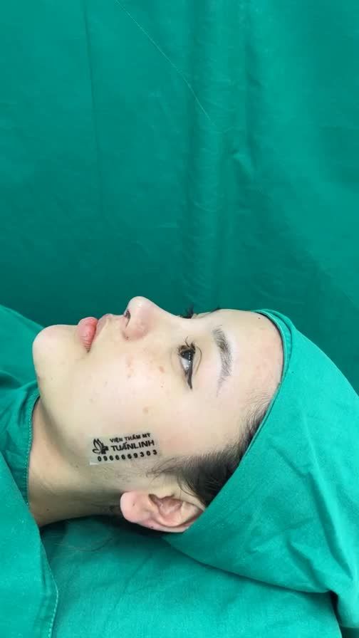 Case mũi cấu trúc vừa hoàn thành