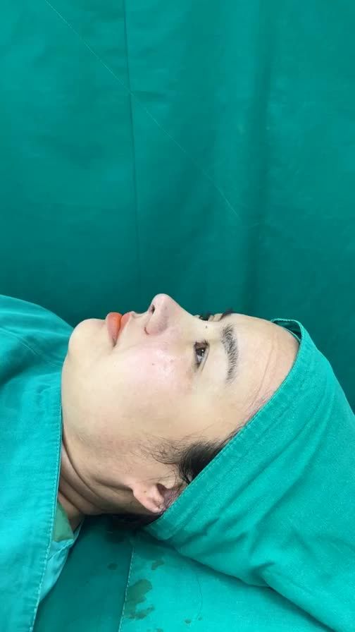 Case mũi cấu trúc surgiform vừa hoàn thành