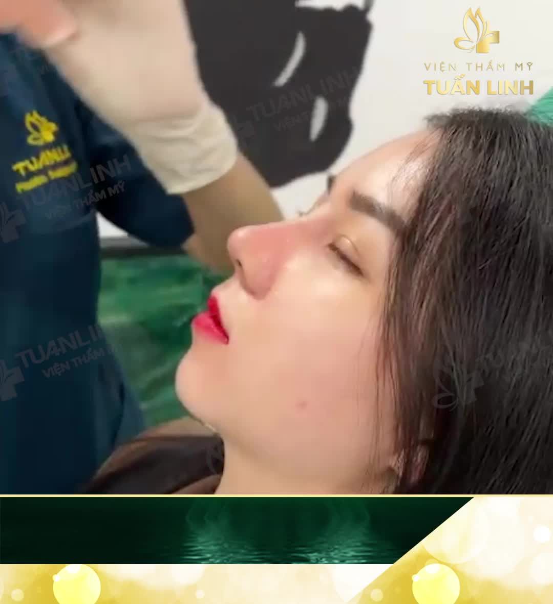 Chỉ với 15TR - 10 ngày có ngay chiếc mũi cao xinh tự nhiên.