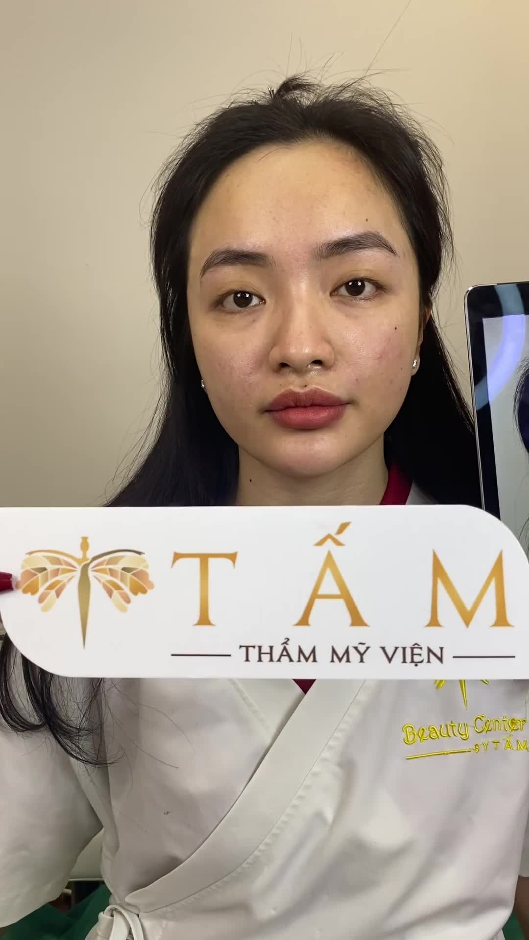 Bạn khách hàng vừa thực hiện xong Combo Filler Má, Thái dương, rãnh cười.