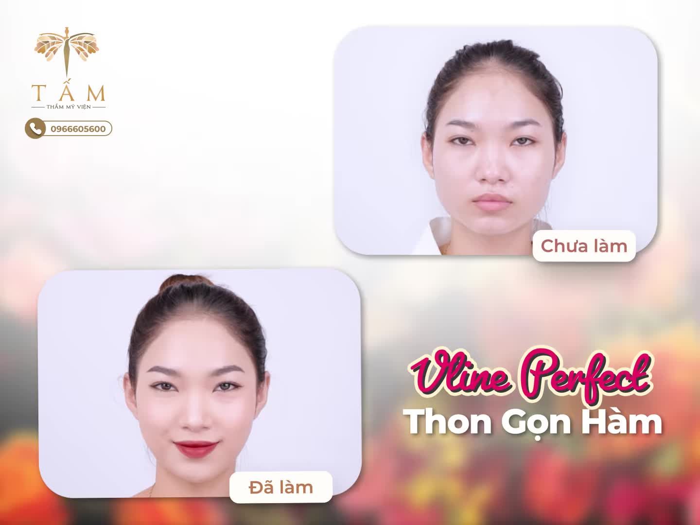 Vline Perfect tự hào là phương pháp gọn hàm hàng đầu Việt Nam