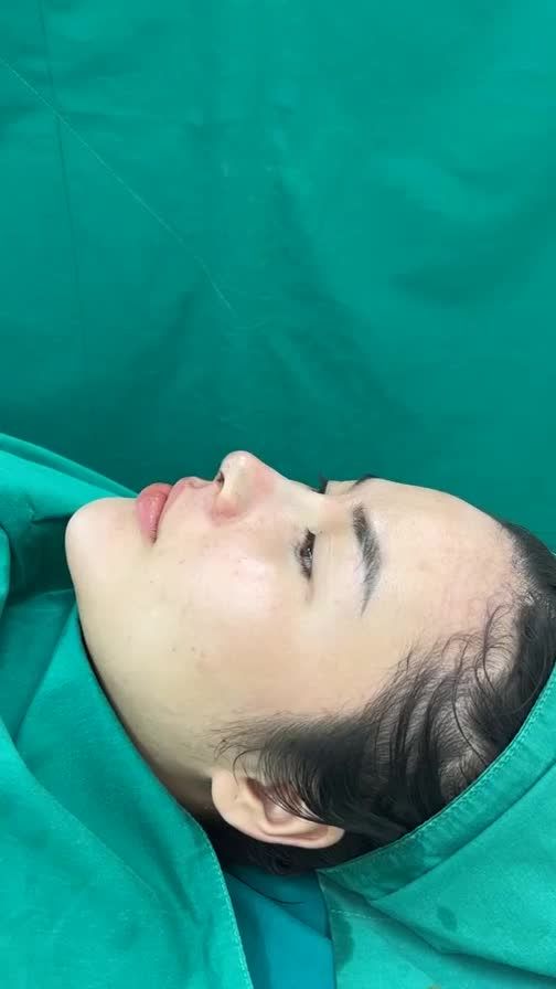 Case mũi cấu trúc vừa hoàn thành