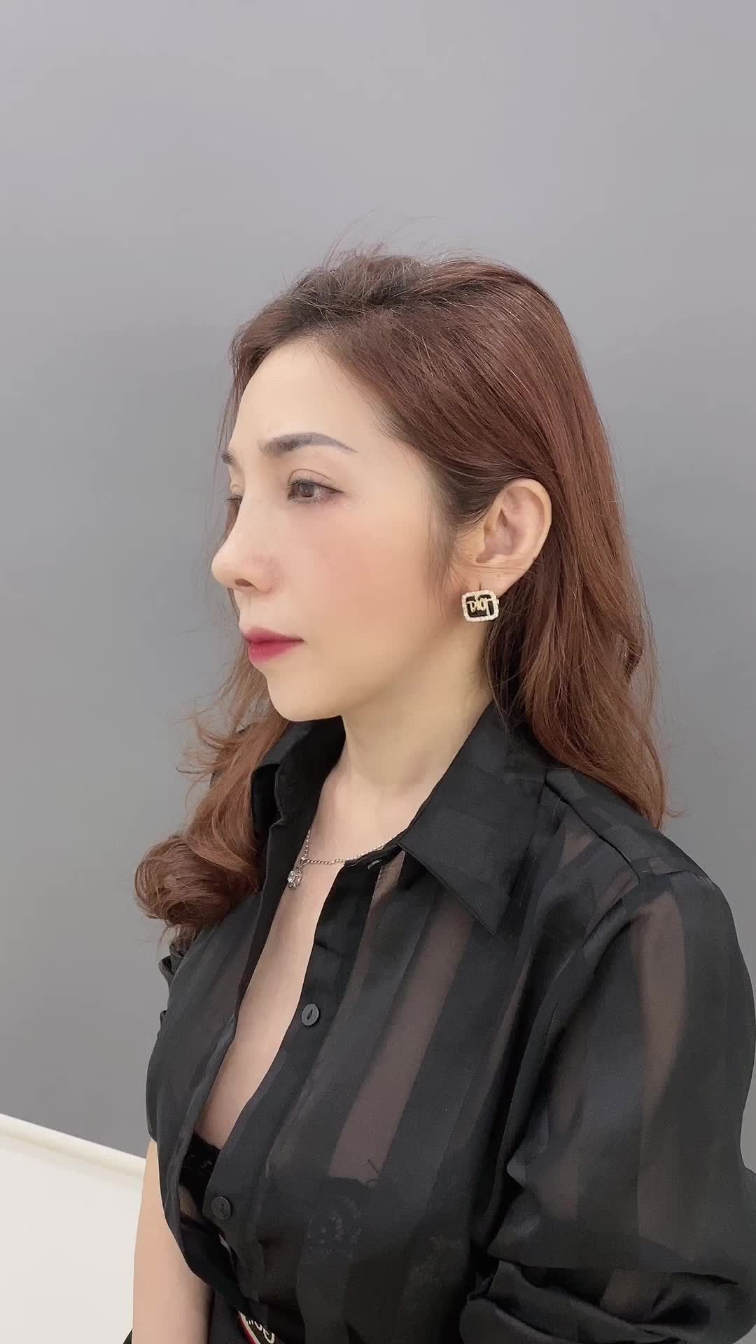 Dáng mũi cấu trúc sau 2 tháng