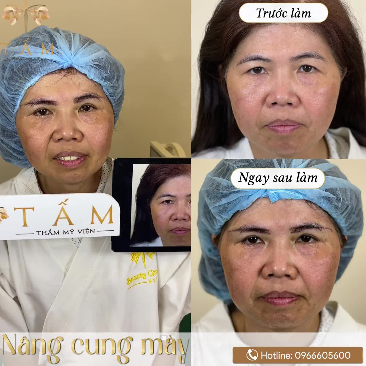 Tìm lại ngay nét thanh xuân với dịch vụ nâng cung mày tại TMV Tấm.
