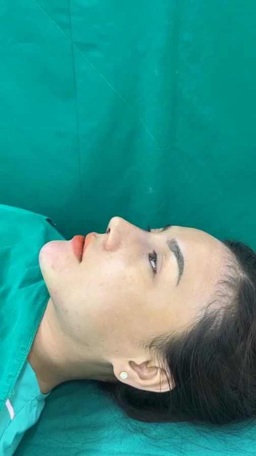 Case combo mũi và cằm vừa hoàn thành