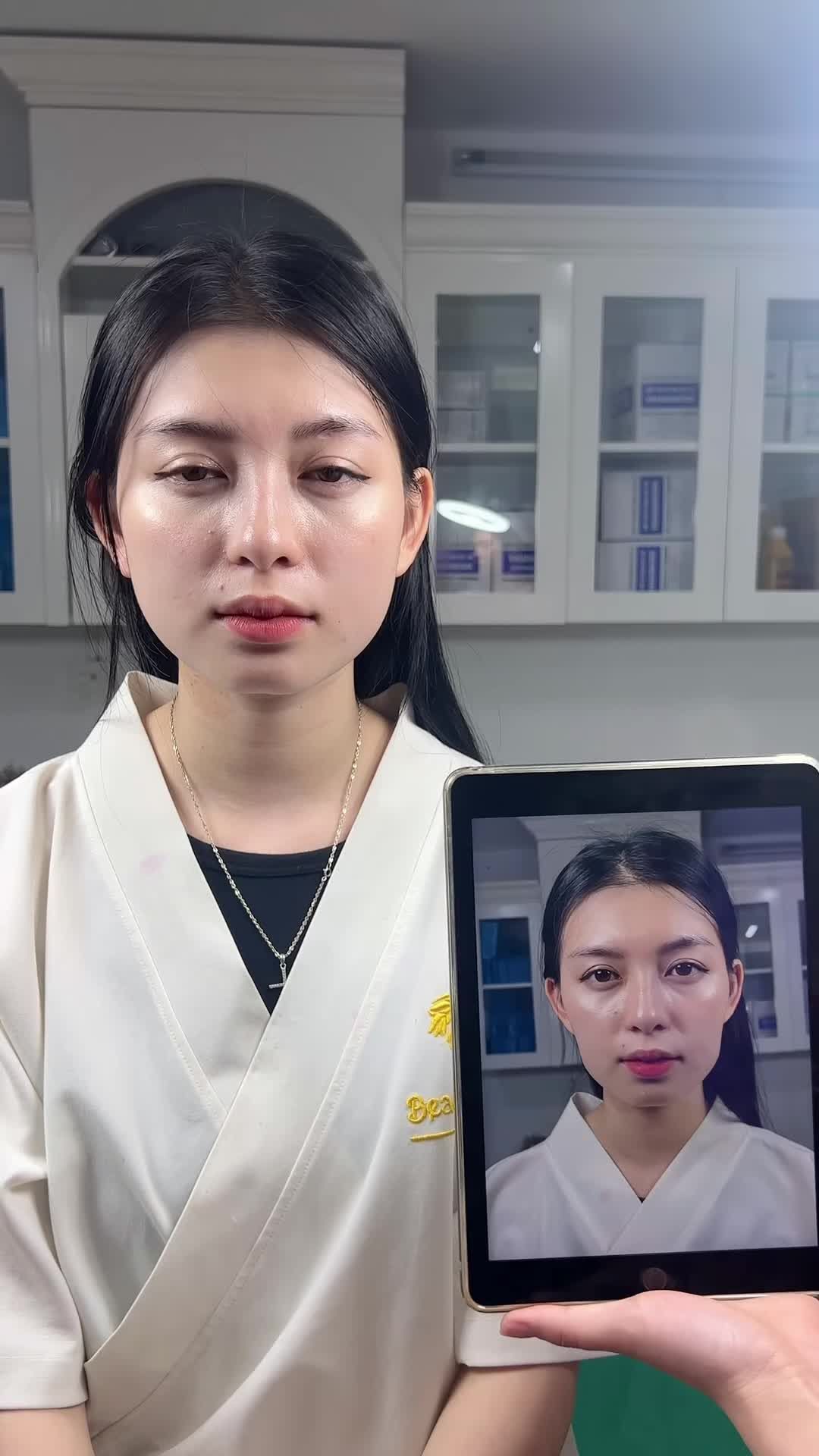 Ca filler má tại phòng khám TMV Tấm.