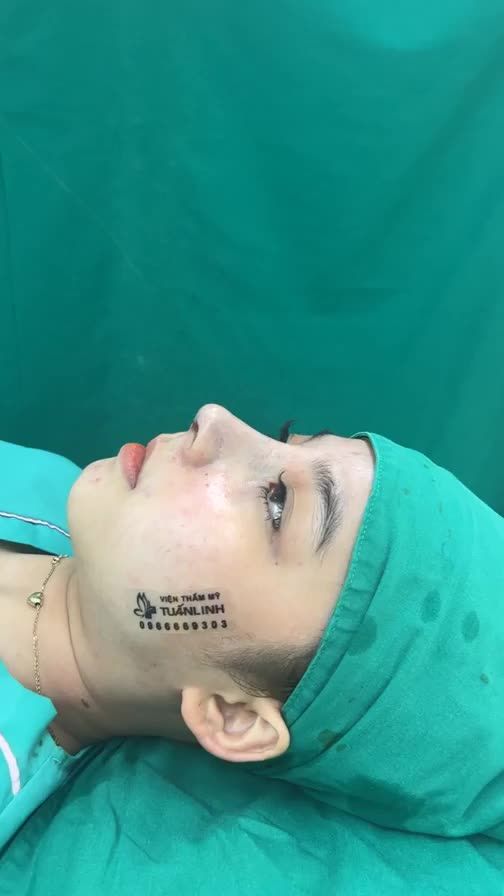 Case mũi cấu trúc vừa hoàn thành