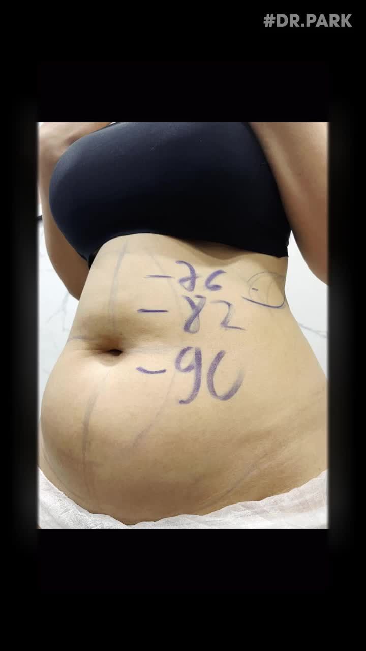 LIPO ULTRASOUND – PHƯƠNG PHÁP HÚT MỠ HIỆN ĐẠI HÀNG ĐẦU BẠN NÊN BIẾT