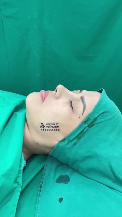 Ca nâng mũi cấu trúc sửa lại  Cho chị gái đã sửa mũi được hơn 10 năm