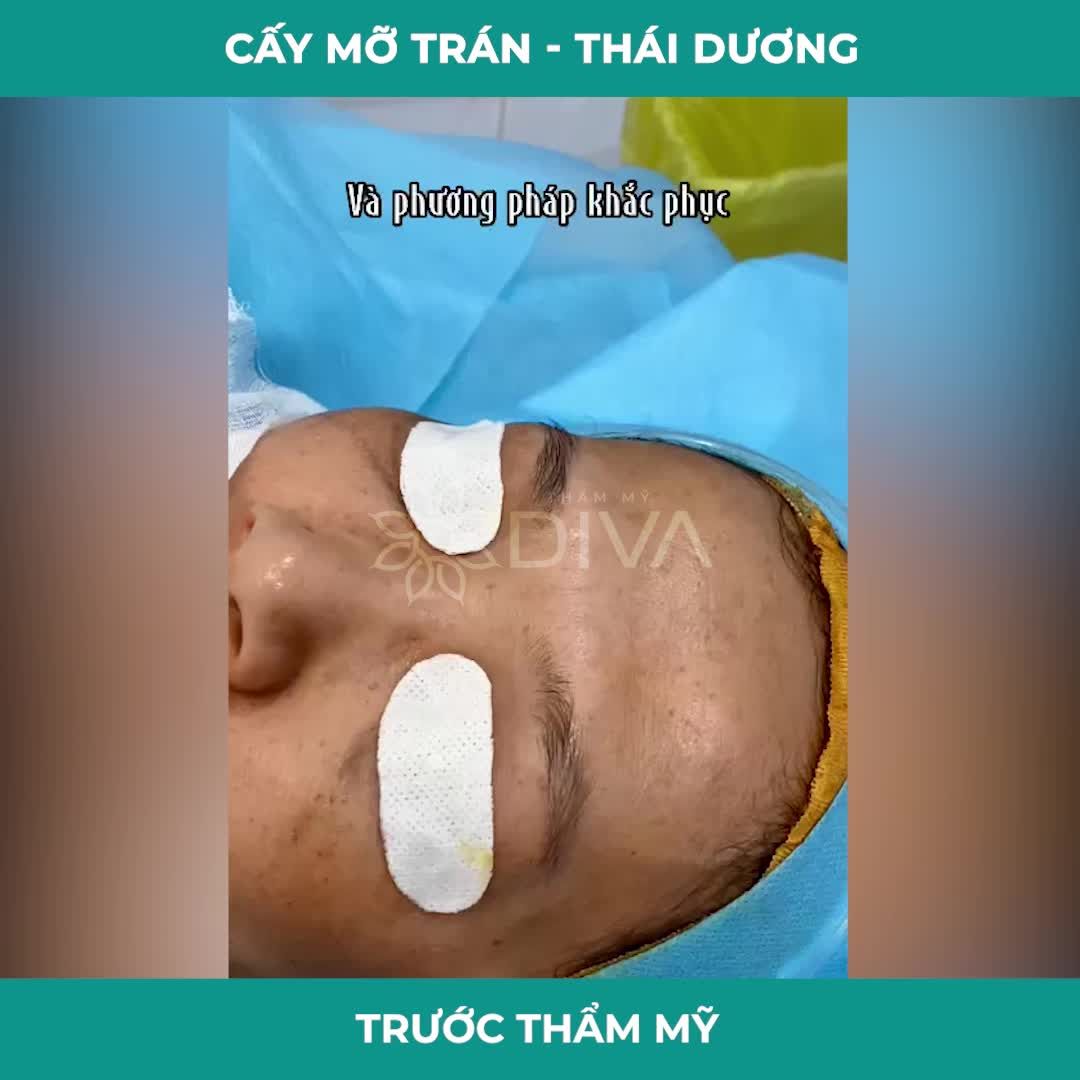 CẢI THIỆN TRÁN LÕM, HỒI XUÂN TỰ NHIÊN VỚI PHƯƠNG PHÁP CẤY MỠ COLEMAN TRÁN