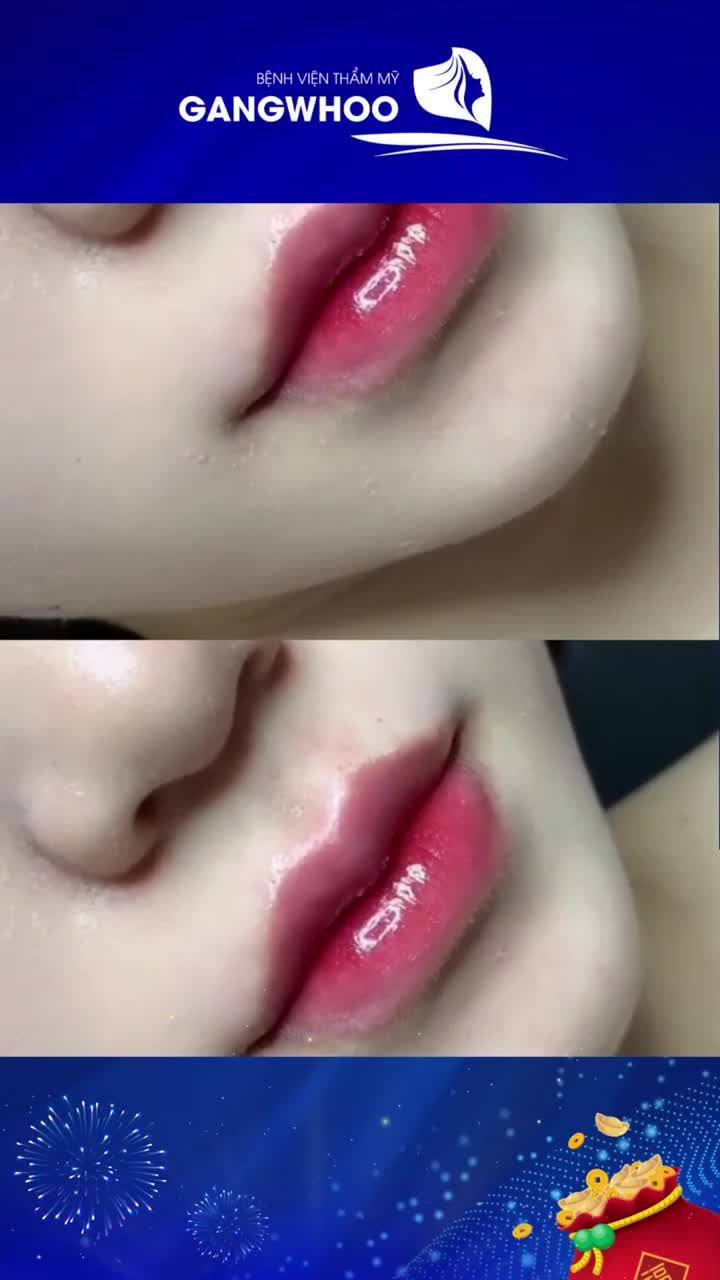 TIÊM FILLER MÔI TRÁI TIM CHO ĐÔI MÔI NGỌT NGÀO QUYẾN RŨ