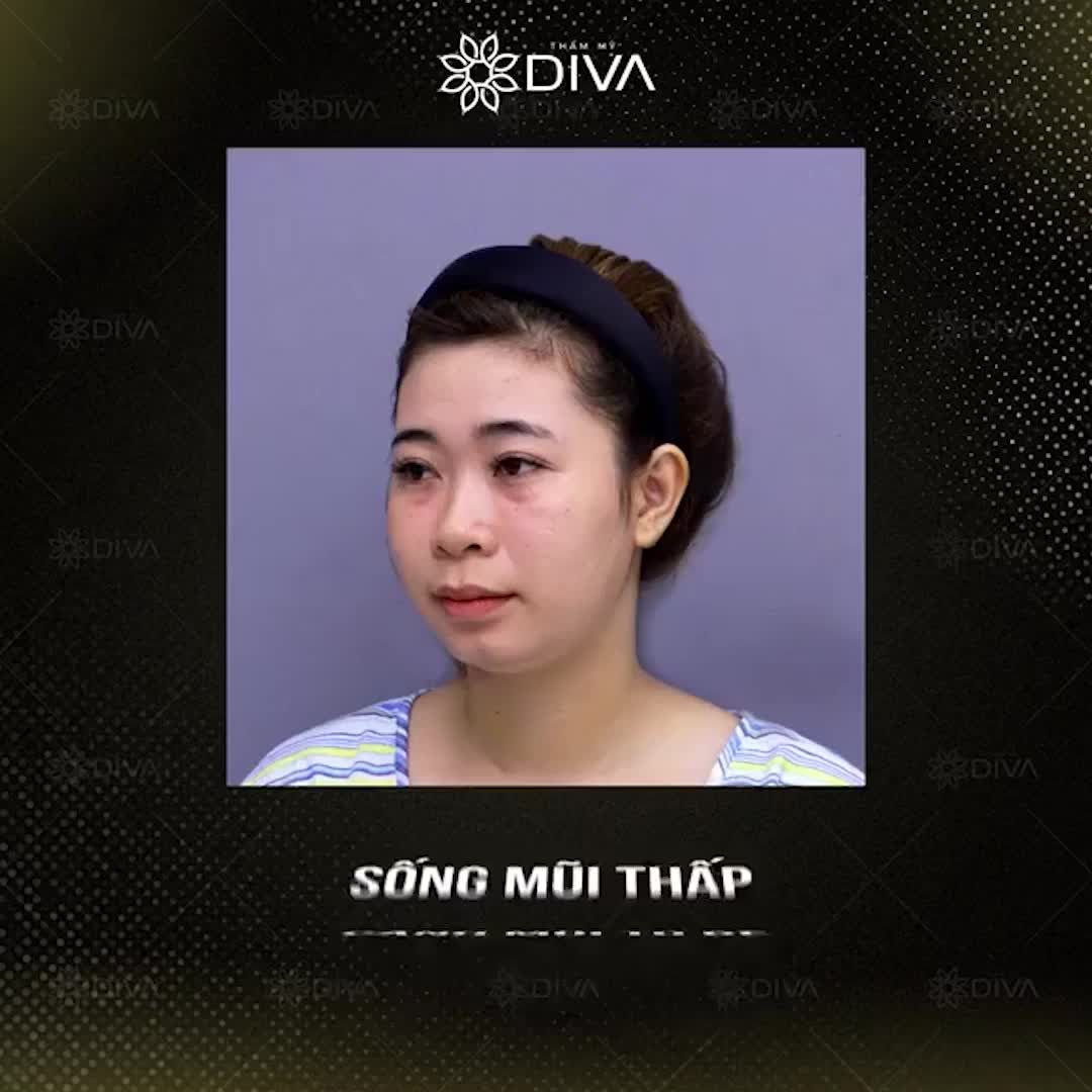DÁNG MŨI CAO THANH THOÁT, TỰ NHIÊN SAU THẨM MỸ