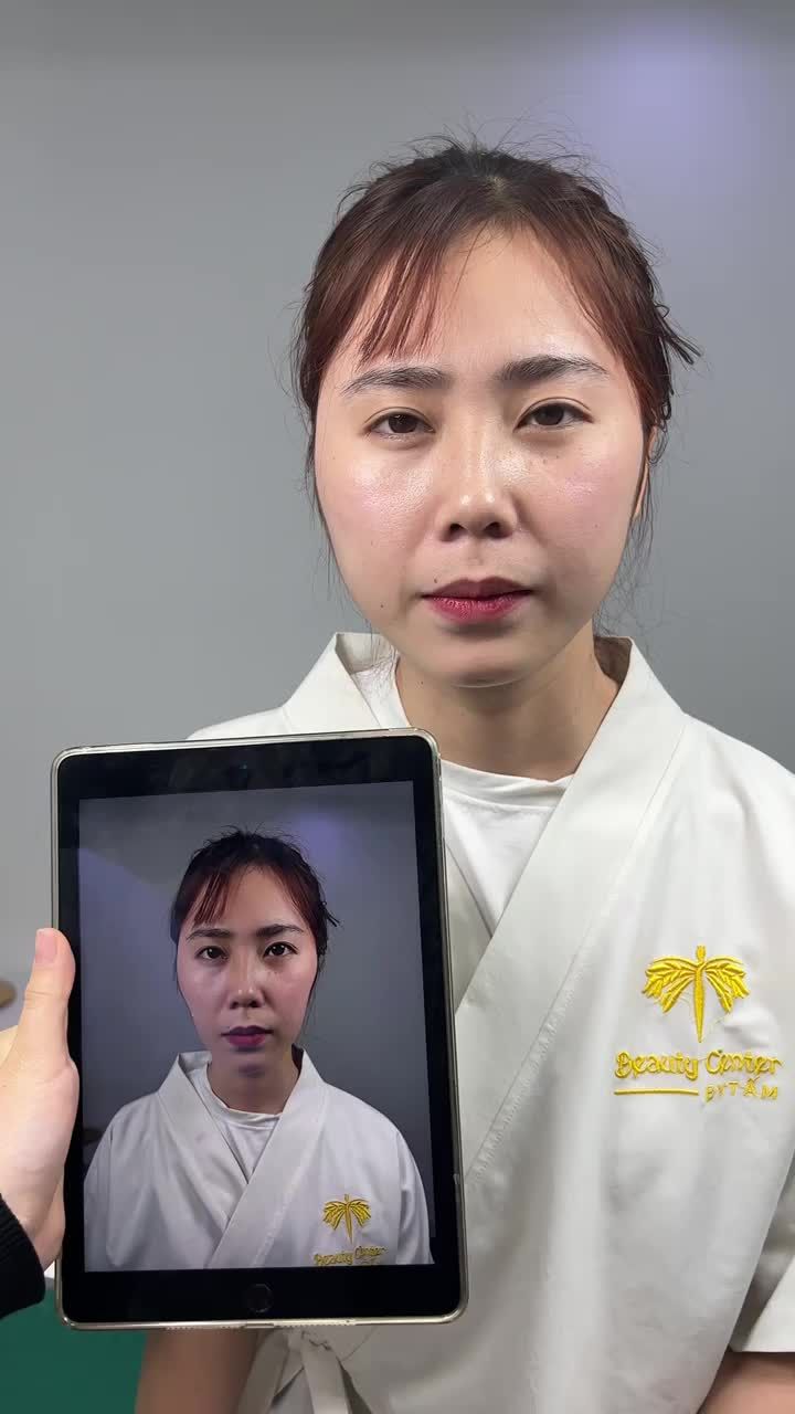 Ca filler đầy má tại phòng khám TMV Tấm.