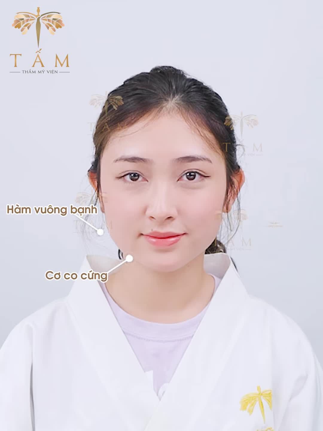 Với tình trạng hàm thô, vuông to khiến cho khuôn mặt trở nên mất cân đối, khách hàng đã được các bác sĩ tại Tấm thăm khám và lựa chọn phương pháp thon gọn hàm Vline
