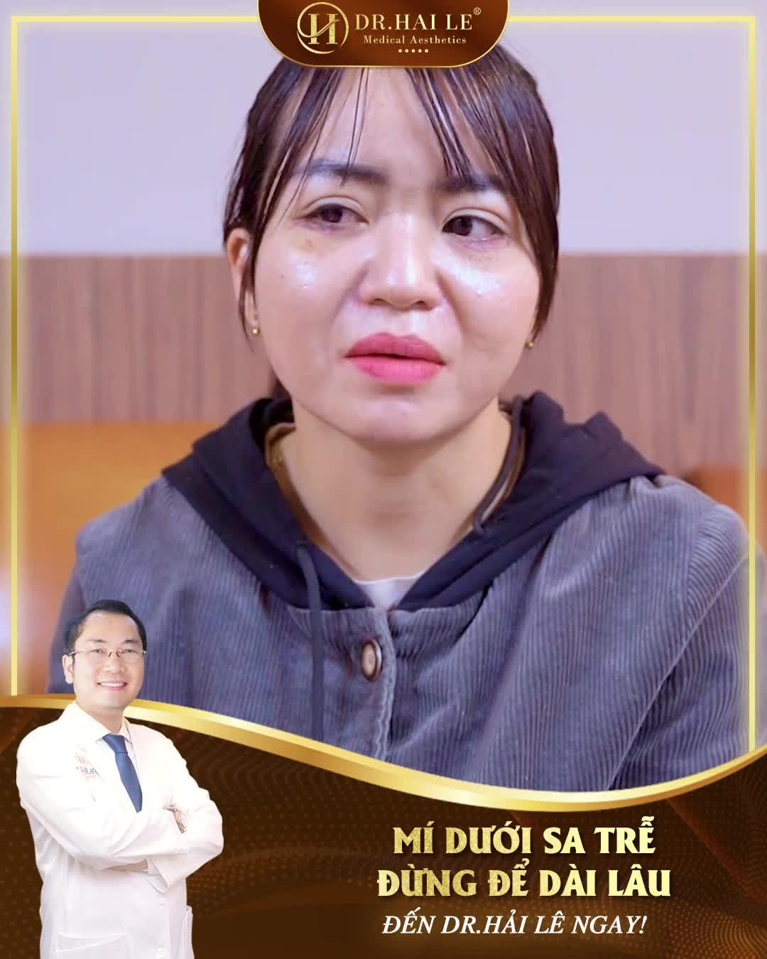 Sau 20 ngày sống chung với mí dưới sa trễ khi thực hiện cắt mí tại cơ sở thẩm mỹ kém uy tín, vị khách hàng đã tức tốc tới ngay Dr.Hải Lê để sửa chữa đôi mắt lỗi, hỏng của mình.
