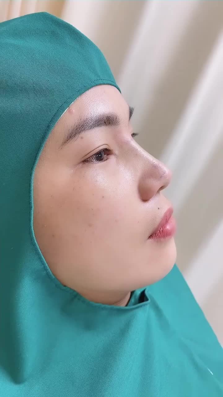 ƯU ĐIỂM NỔI BẬT CỦA NÂNG MŨI BỌC SỤN TAI
