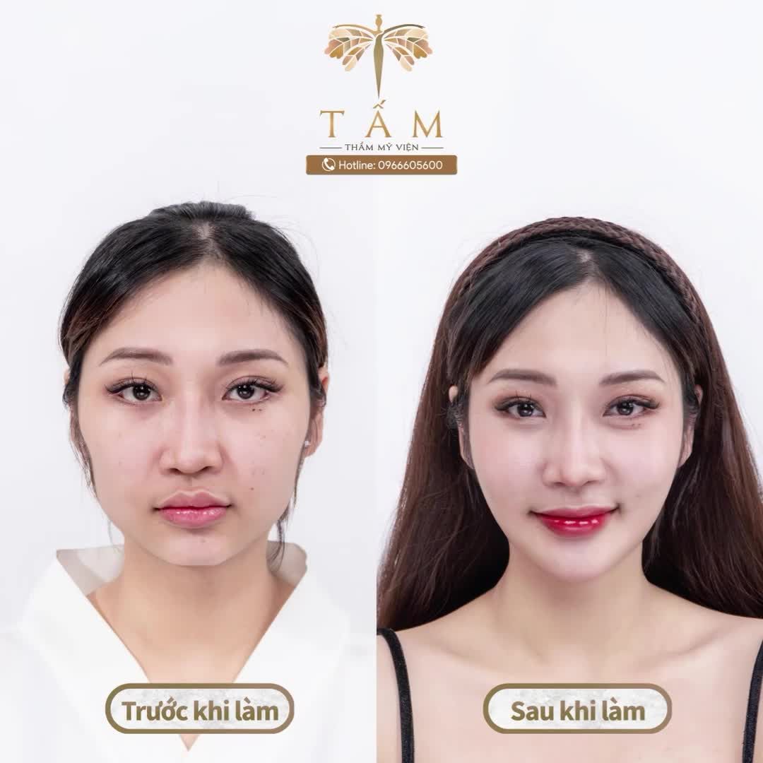 Làm đẹp an toàn, không lộ PTTM nhờ Filler tại Tấm
