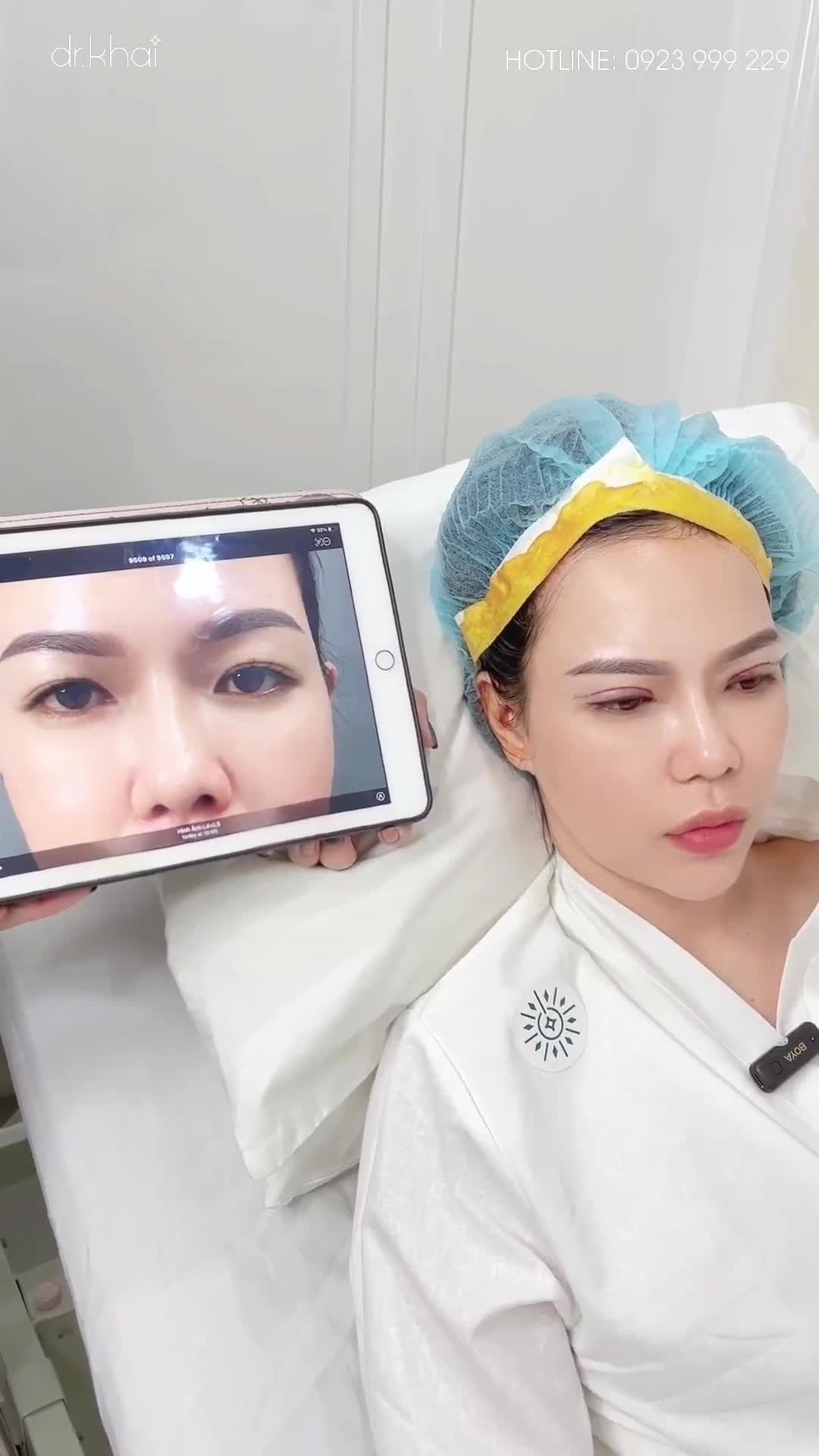 MẮT ĐẸP TỰ NHIÊN - KHÔNG SƯNG BẦM KHI CẮT MÍ TẠI BÁC SĨ KHẢI