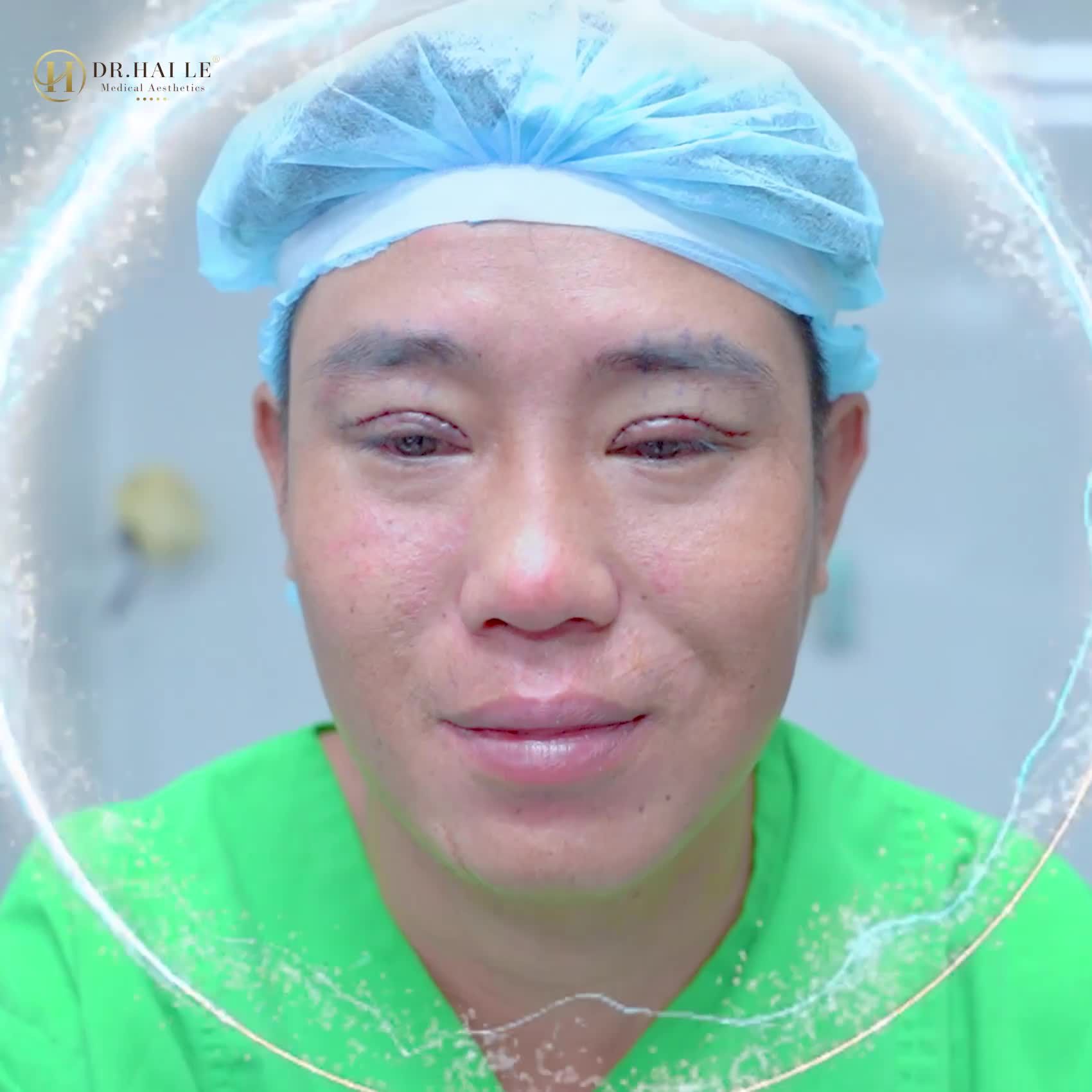 Lặn lội từ Phú Yên đến Dr.Hải Lê- Sài Gòn khắc phục sụp mí bẩm sinh. Liệu kết quả có như mong đợi của chàng trai 28 tuổi. Xem ngay kẻo lỡ!