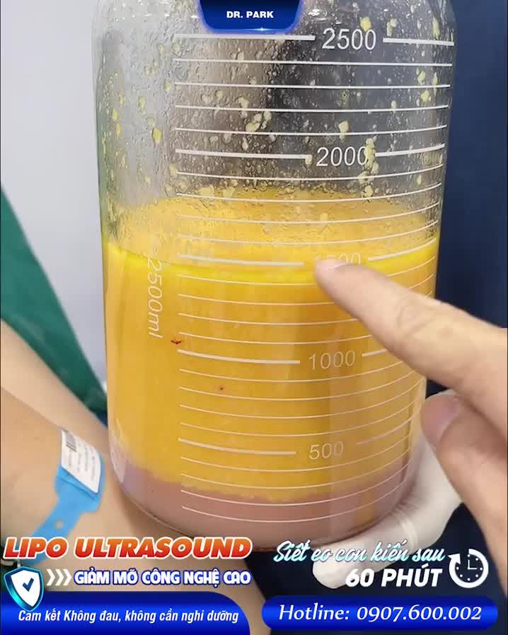 LIPO ULTRASOUND – GIẢI PHÁP GIẢM MỠ DÀNH TẶNG CHO MẸ SAU SINH