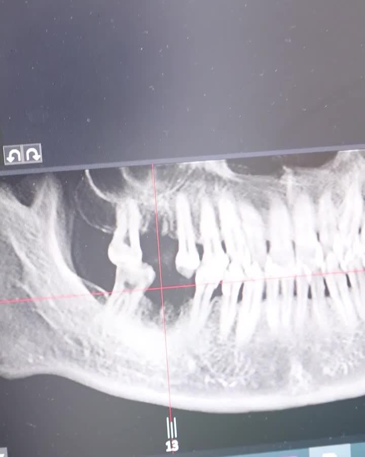 Có phải ai mất răng cũng trồng được răng Implant?