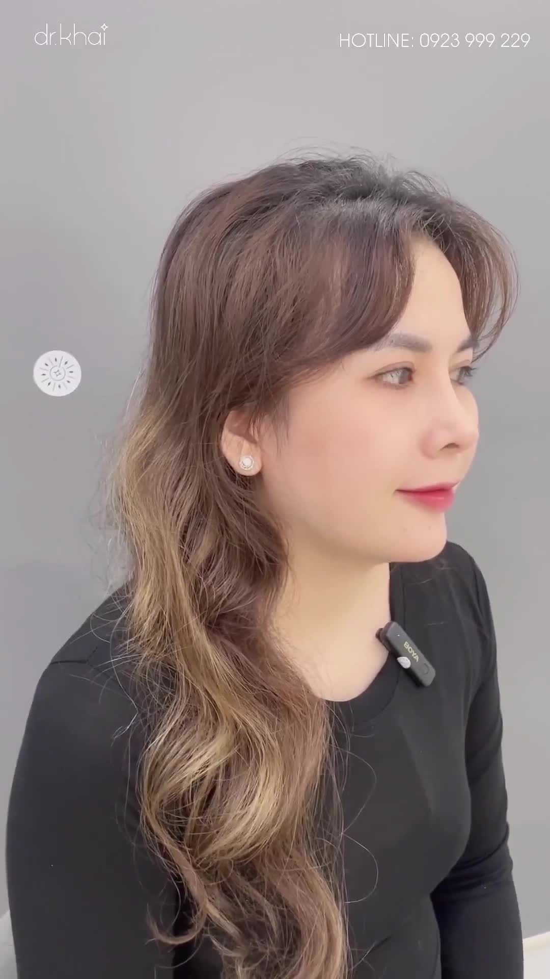 PHẪU THUẬT TẠO HÌNH MŨI CẤU TRÚC PHONG THỦY KẾT HỢP CHỈNH HỞ LỖ MŨI