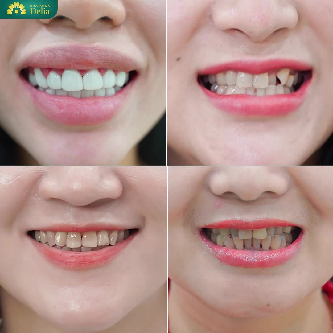 Răng trắng sáng - Bền đẹp trọn đời chỉ sau 02 lần hẹn