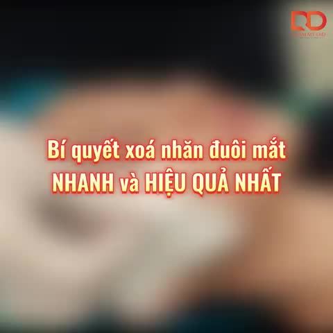 PHƯƠNG PHÁP XOÁ NHĂN ĐUÔI MẮT HIỆU QUẢ NHẤT