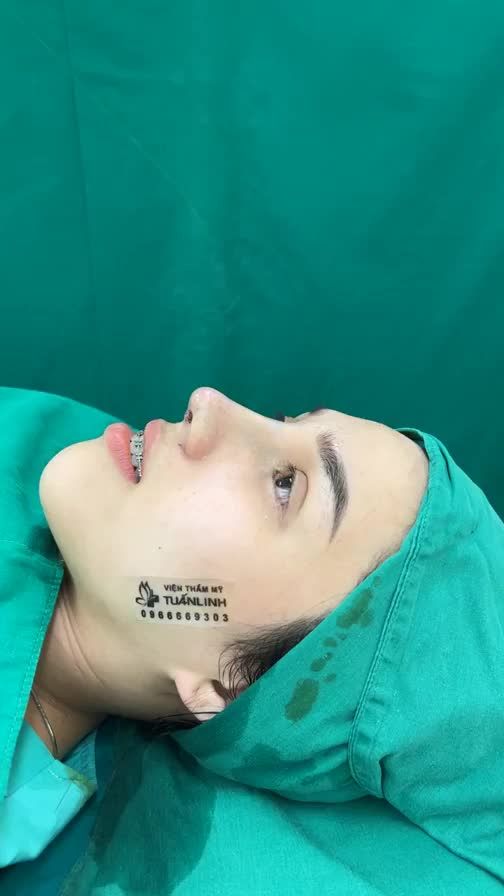 Case mũi cấu trúc surgiform vừa hoàn thành