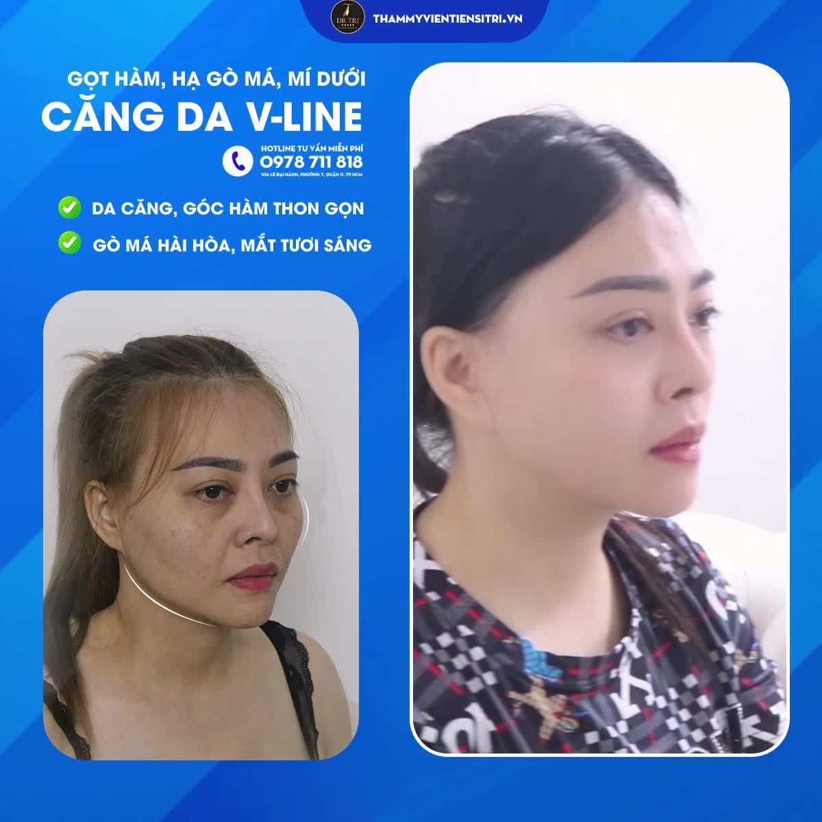 Combo Hạ gò má Gọt hàm Mí dưới Căng da VLine tạo hình lại gương mặt trẻ trung mềm mại cho Khách từ Mỹ
