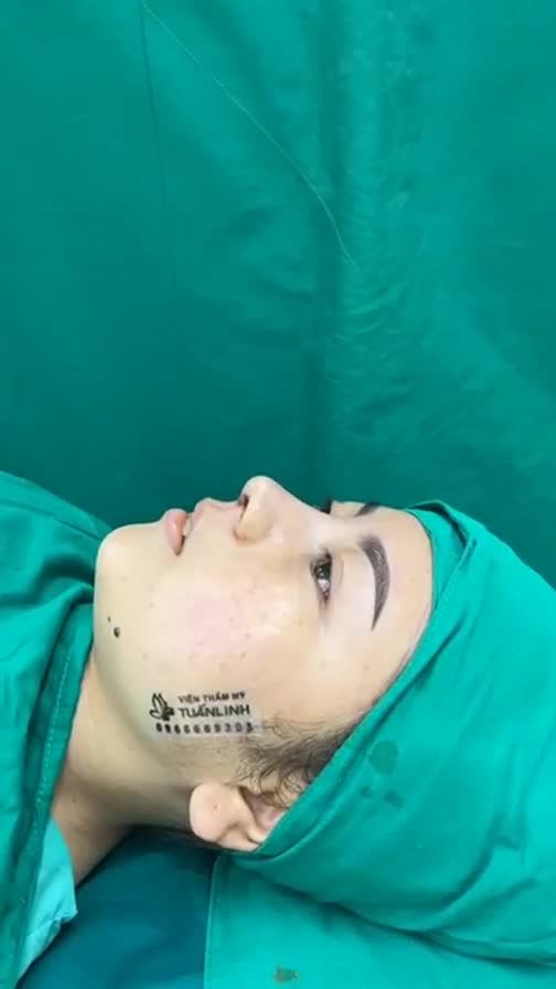 Combo nâng mũi độn cằm cắt môi vừa hoàn thành