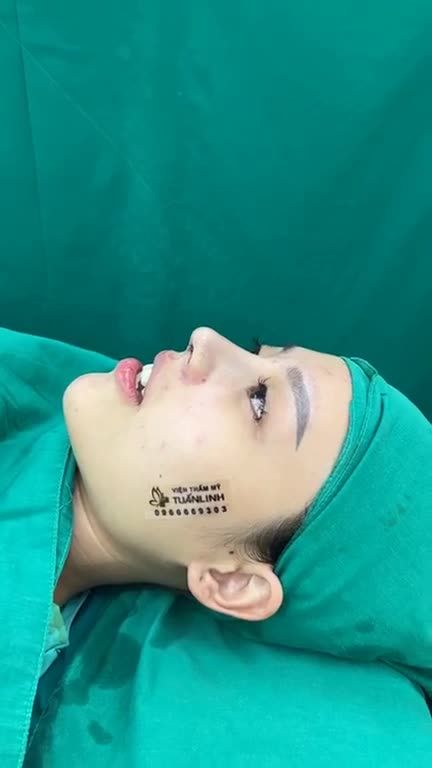 Case mũi cấu trúc vừa hoàn thành