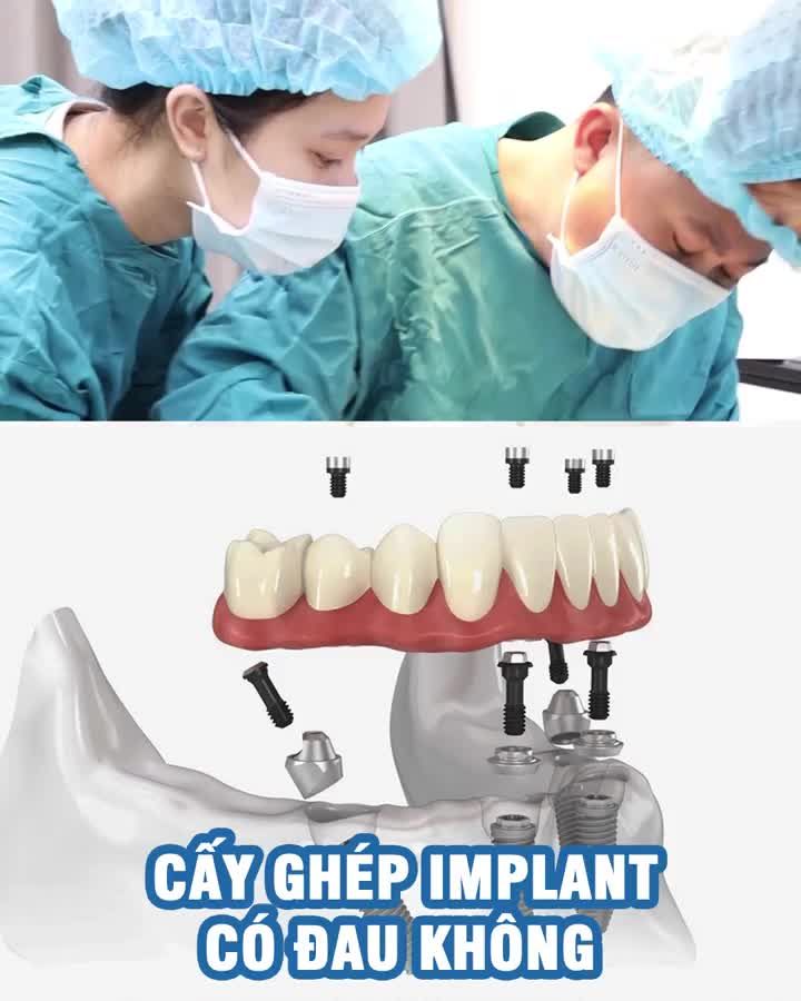 Cấy ghép răng Implant có đau không?