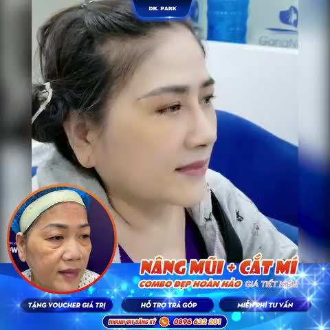 NÂNG MŨI - CẮT MÍ - COMBO CHO BẠN THAY ĐỔI 180 ĐỘ